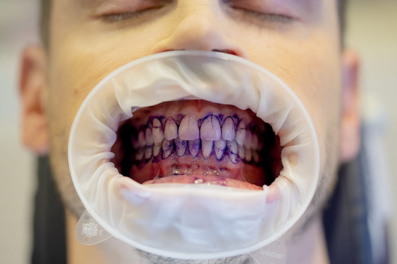 Mund mit Lippenretraktor geöffnet; Zähne mit Markierungen für eine Zahnbehandlung